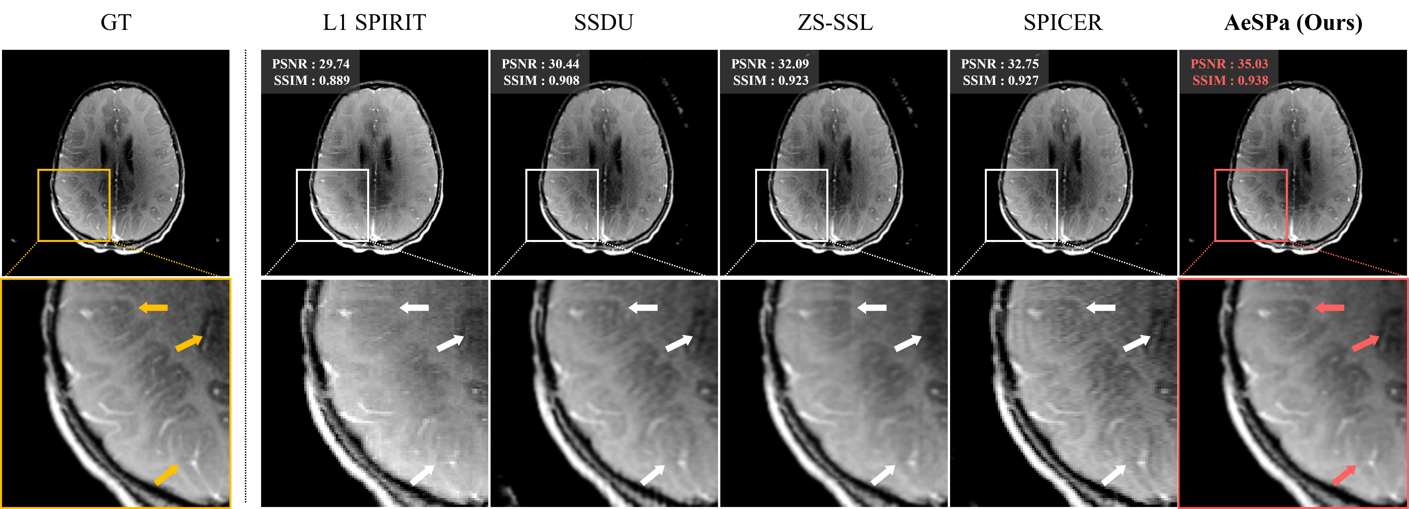 FastMRI Brain Results