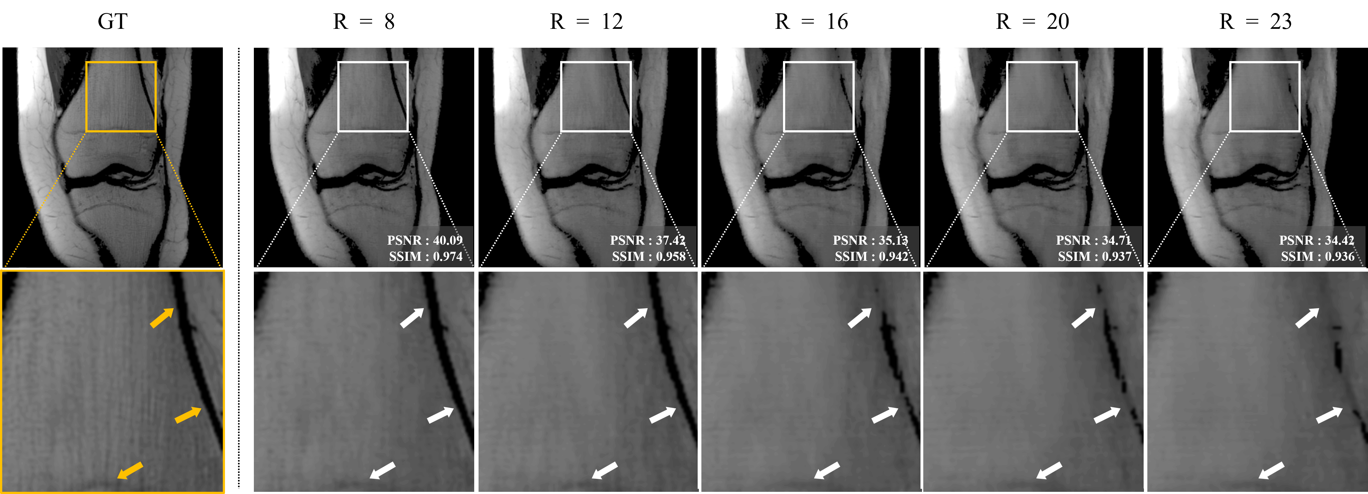 FastMRI Knee Reduction Factors Results
